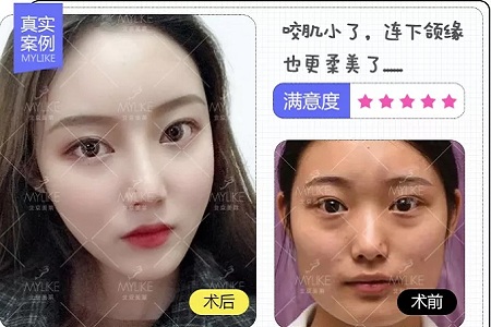 ?讓你擁有V臉、香肩、細(xì)腿的神器--玻尿酸的作用原理你真的知道嗎？