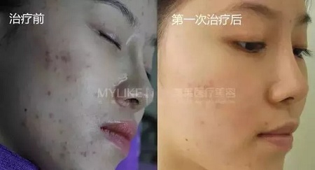 愛長痘痘的你，應(yīng)該試試這道光！