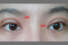 雙眼皮失敗了怎么辦？鄭州美萊醫(yī)院助你重獲新生