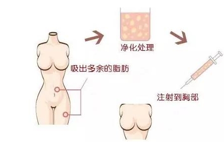 曲靖自體脂肪豐胸維持多久？有哪些優(yōu)點
