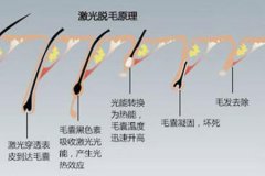 蘇州脫毛醫(yī)院做冰點(diǎn)脫毛的價(jià)格多少，對(duì)身體有沒(méi)有傷害