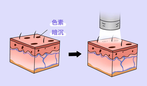 想要嫩膚，應(yīng)該選擇做光電還是水光